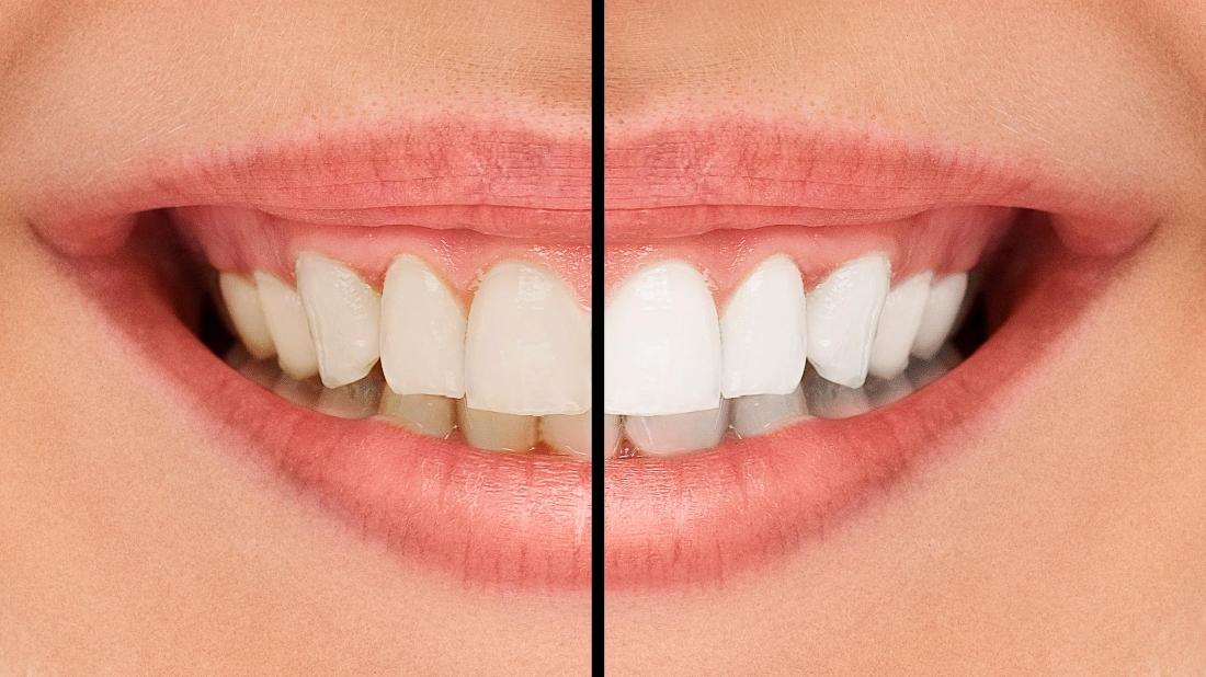 Teeth Whitening Fayetteville AR Is it Safe?