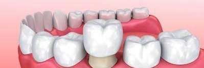 An graphic illustration of Same-Day Dental Crown in Fayetteville, AR