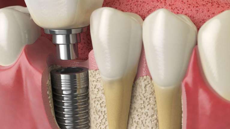 A molar Dental implant surrounded by natural teeth in Arkansas
