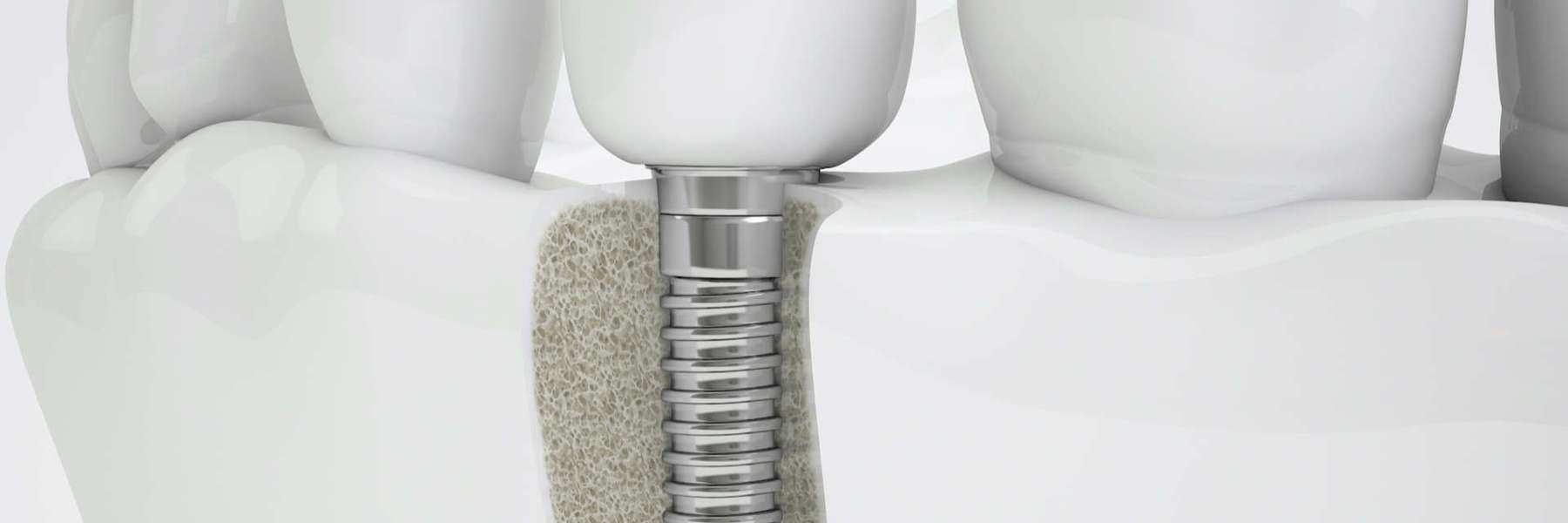 An illustration of a Dental Implants in Fayetteville, AR