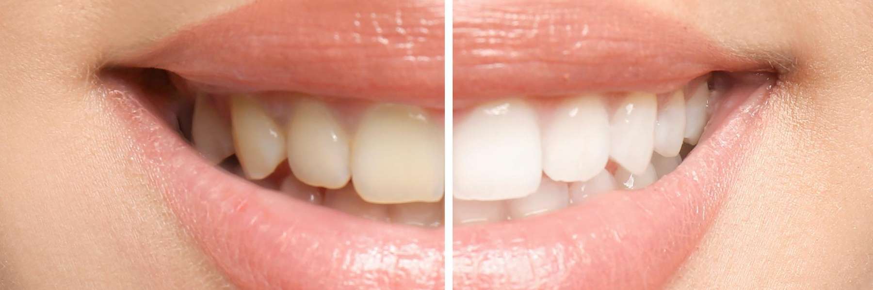 A before and after results of teeth whitening in Fayetteville, AR