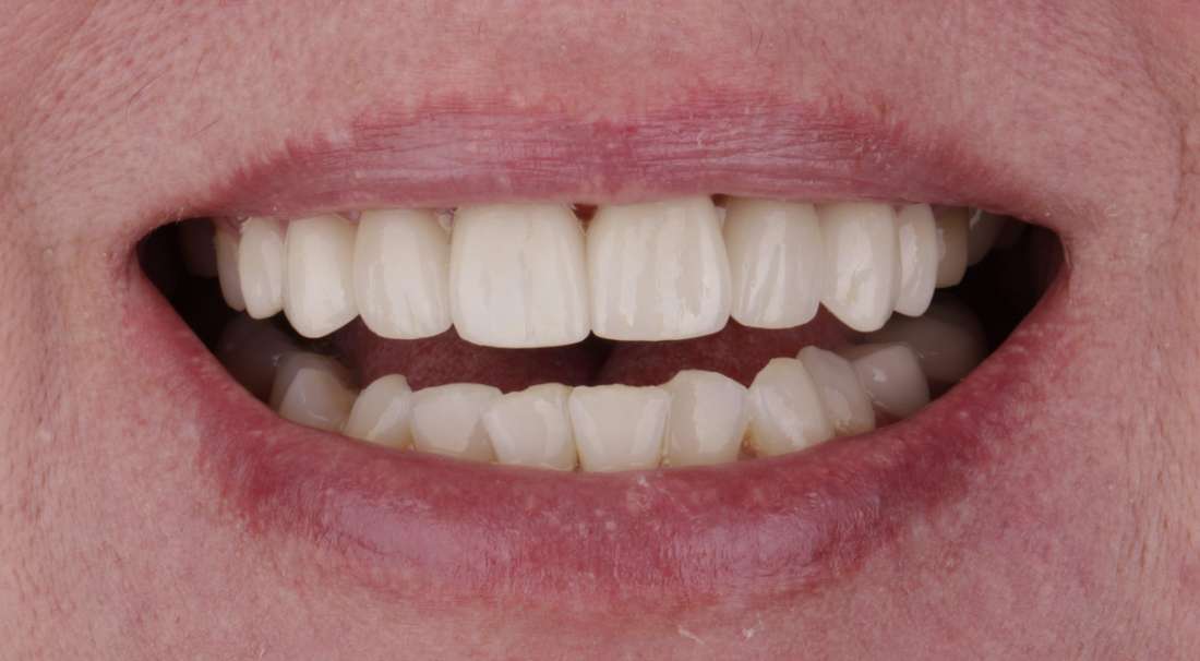 dental crowns fayetteville- after