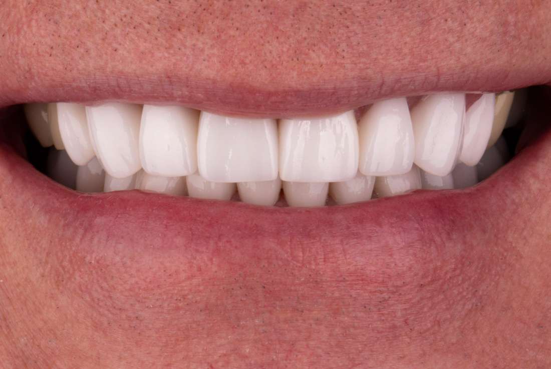 Smile makeover in Fayetteville- After