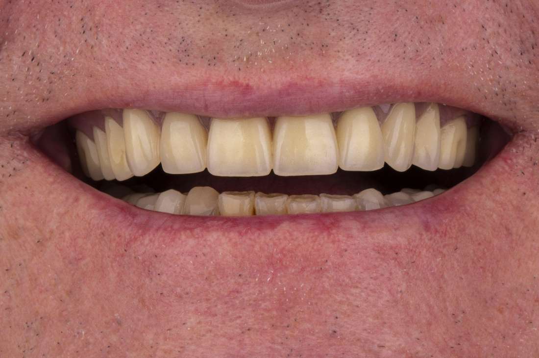 Implants in Fayetteville, AR- After