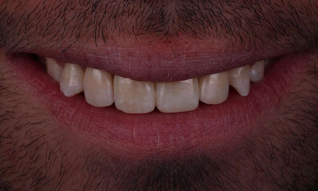 dental implants for missing front teeth