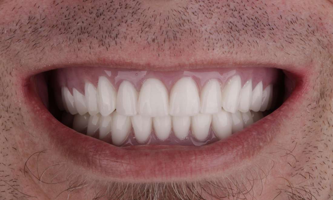 After Dentures