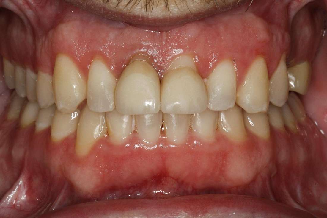 Same Day Crowns in Fayetteville, AR- Before