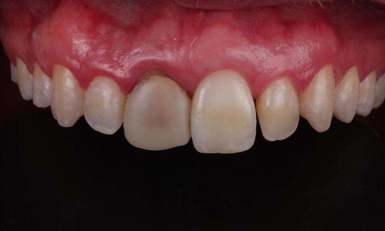 Misshapen and discolored crown
