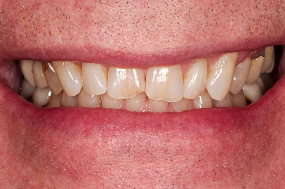 Smile makeover in Fayetteville- Before