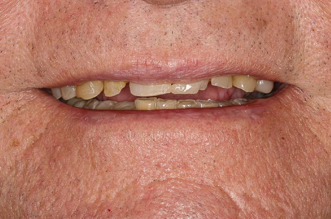Implants in Fayetteville, AR- Before