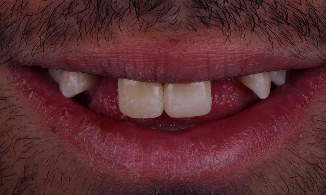 missing teeth