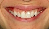 cured front tooth with dental implant