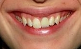compromised front tooth