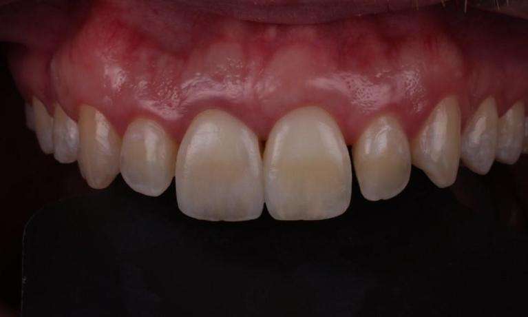 Dental-Crowns-For-Misshapen-Teeth-After-Image
