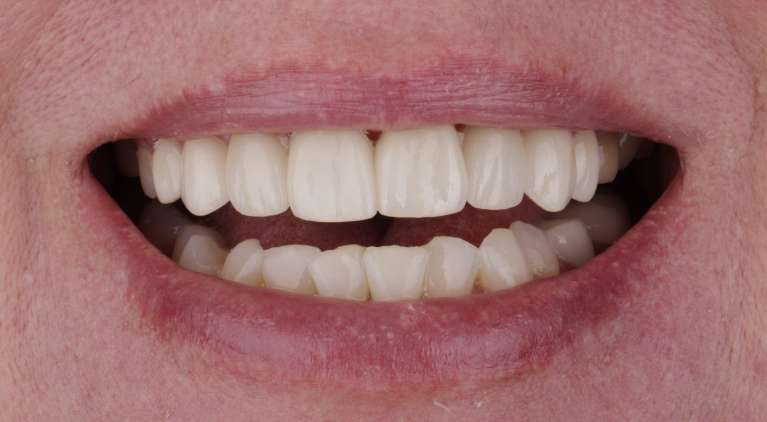 dental crowns fayetteville- after