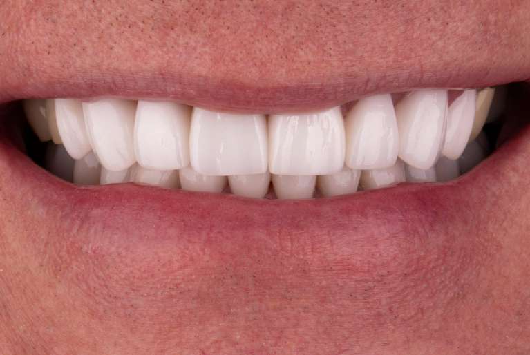 Smile makeover in Fayetteville- After