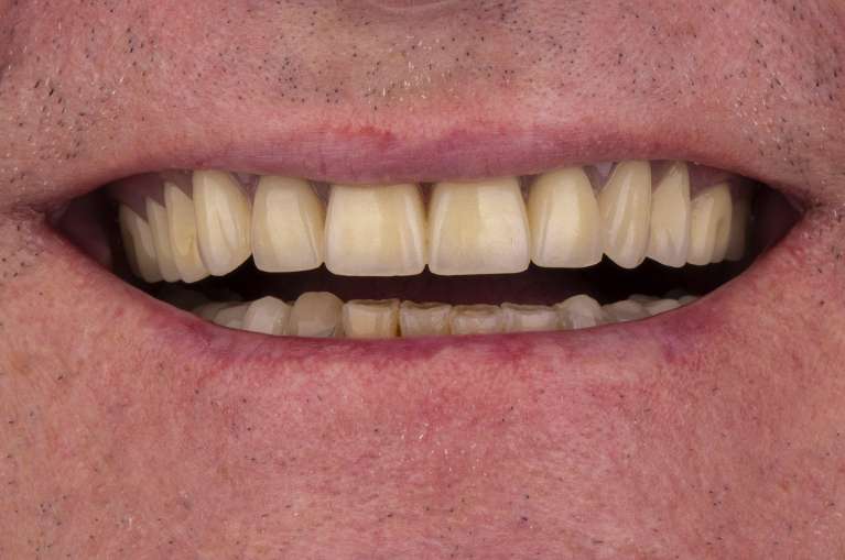 Implant-Retained-Denture-Overdenture-After-Image