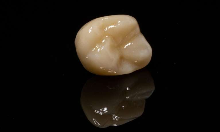 Same-Day-Dental-Crowns-After-Image
