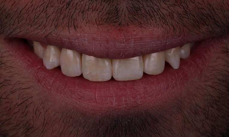 dental implants for missing front teeth