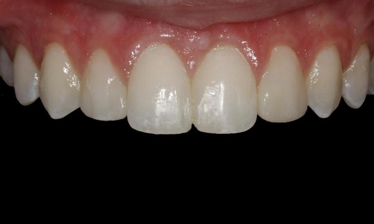 Veneers-and-Cosmetic-Bonding-After-Image