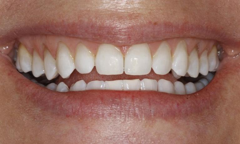 Deep-Bleaching-Whitening-After-Image