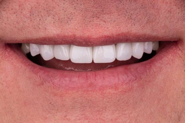 Full-Mouth-Rehabilitation-After-Image