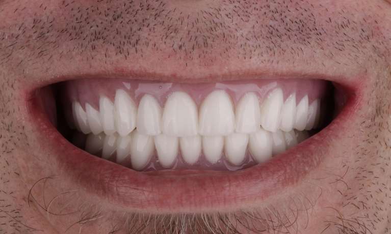 Dentures-and-Partials-After-Image