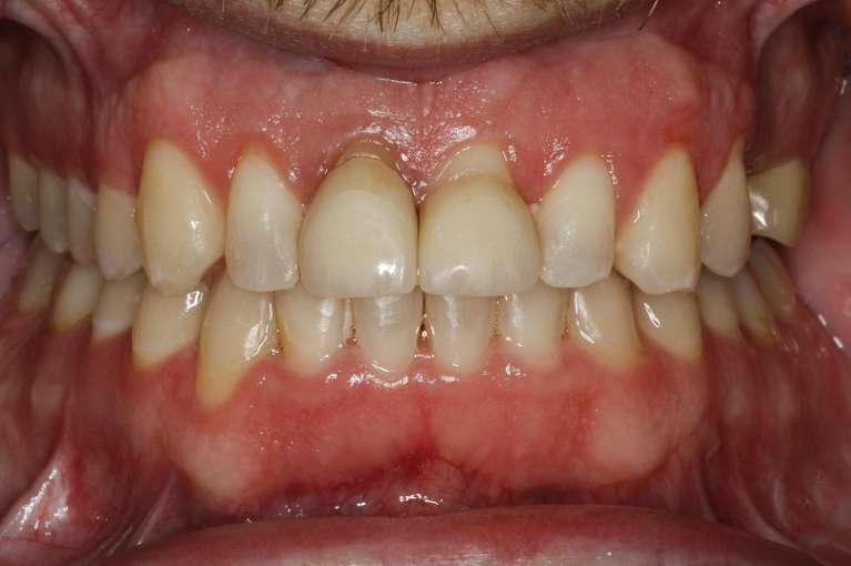 Same Day Crowns in Fayetteville, AR- Before