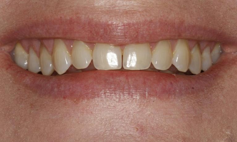 Deep-Bleaching-Whitening-Before-Image