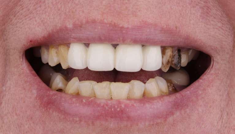 dental crowns fayetteville- before
