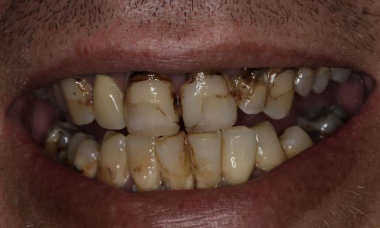 Dentures-and-Partials-Before-Image