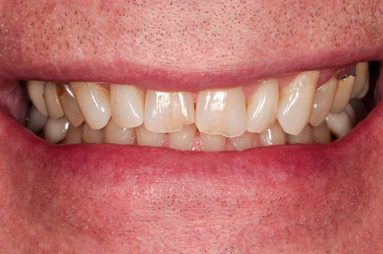 Smile makeover in Fayetteville- Before