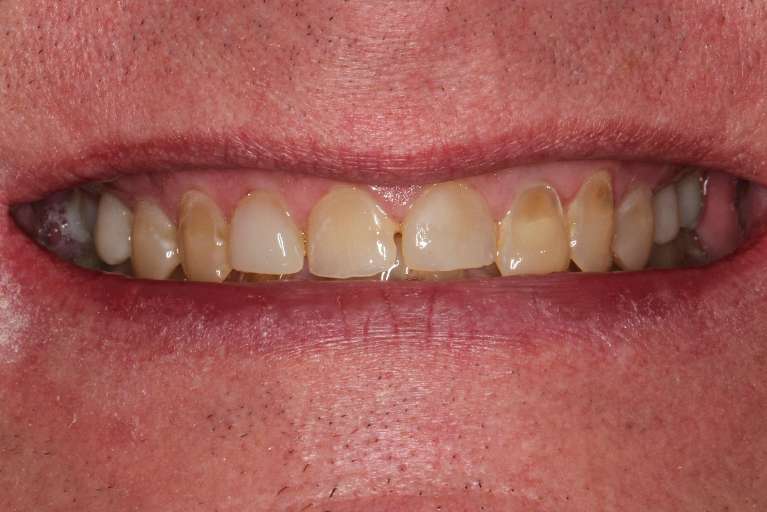 Full-Mouth-Rehabilitation-Before-Image