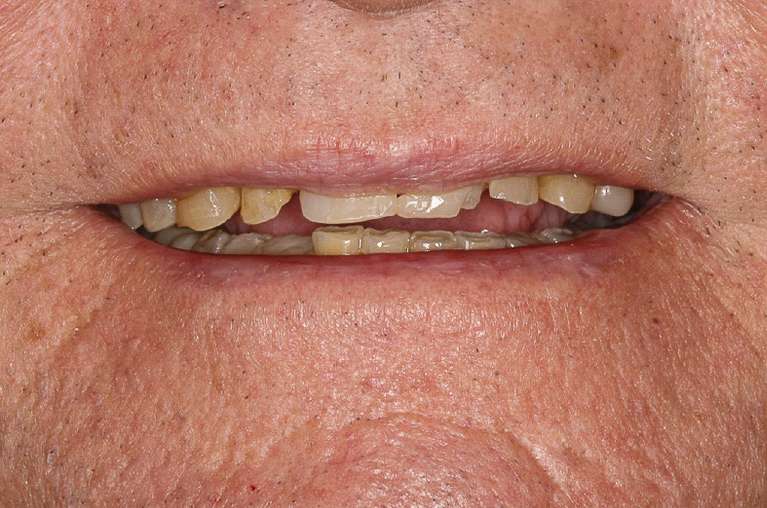 Implant-Retained-Denture-Overdenture-Before-Image