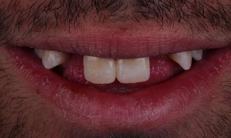 missing teeth